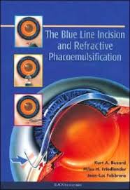 The Blue Line Incision and Refractive Phacoemulsification  