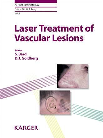 Laser Treatment of Vascular Lesions 